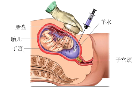 怀孕可以抽血做亲子鉴定吗（母体静脉血亲子鉴定准吗）